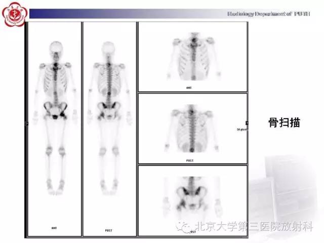 【病例】骨关节结核1例X线CT及MR一例影像表现