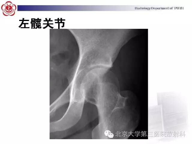【病例】骨关节结核1例X线CT及MR一例影像表现