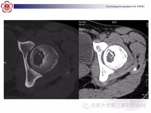 【病例】骨关节结核1例X线CT及MR一例影像表现
