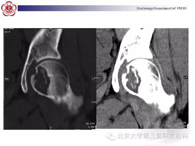 【病例】骨关节结核1例X线CT及MR一例影像表现
