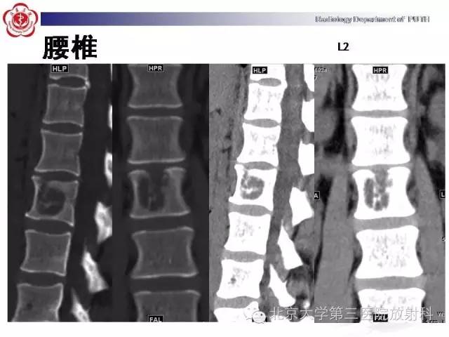 【病例】骨关节结核1例X线CT及MR一例影像表现