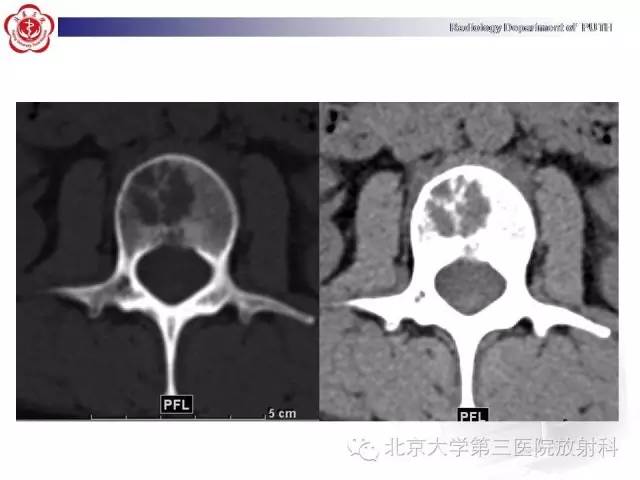 【病例】骨关节结核1例X线CT及MR一例影像表现