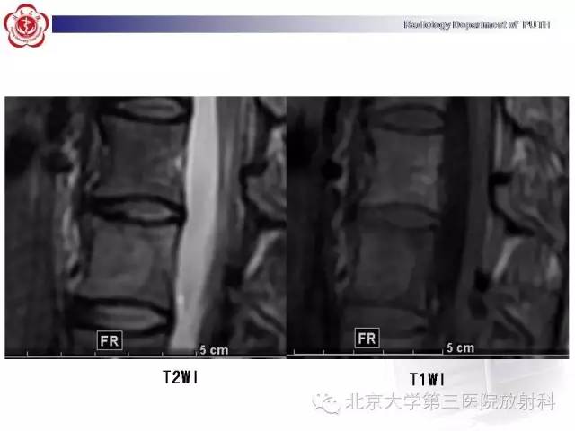 【病例】骨关节结核1例X线CT及MR一例影像表现