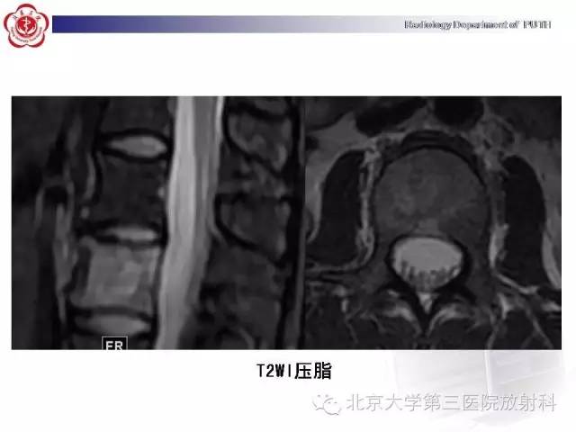 【病例】骨关节结核1例X线CT及MR一例影像表现