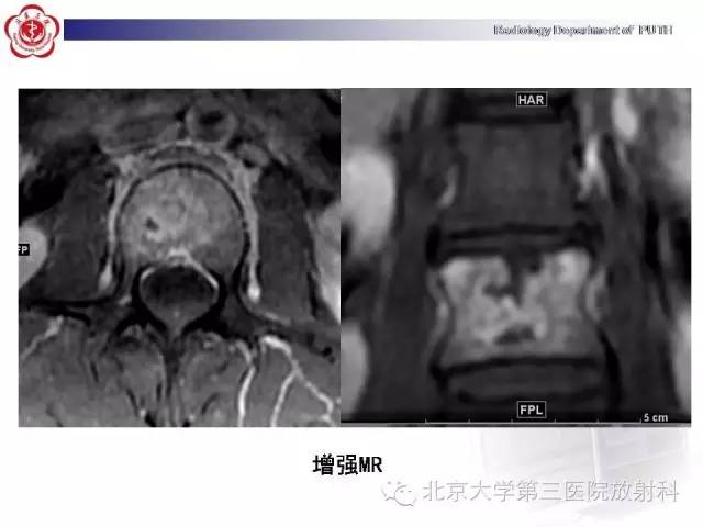 【病例】骨关节结核1例X线CT及MR一例影像表现