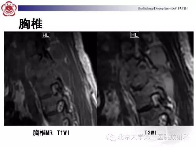 【病例】骨关节结核1例X线CT及MR一例影像表现