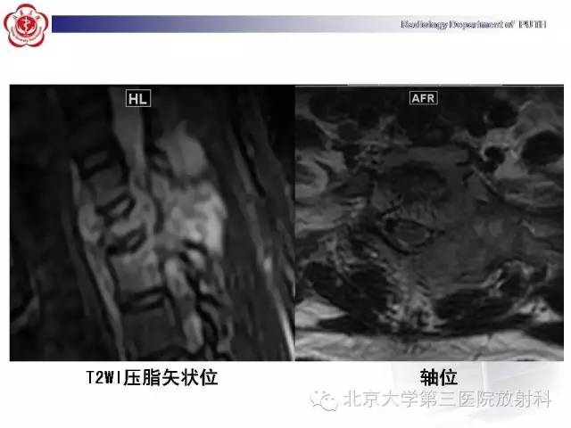 【病例】骨关节结核1例X线CT及MR一例影像表现
