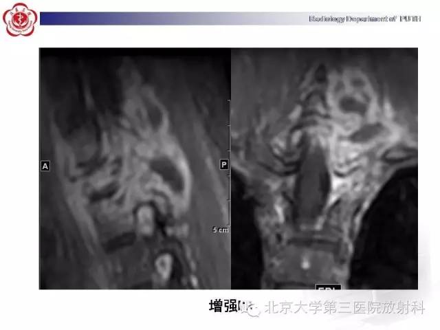 【病例】骨关节结核1例X线CT及MR一例影像表现