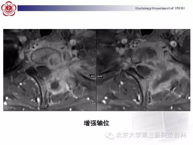 【病例】骨关节结核1例X线CT及MR一例影像表现