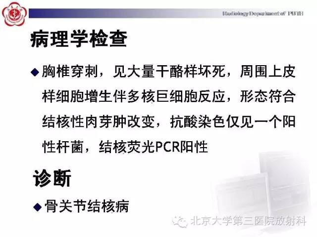 【病例】骨关节结核1例X线CT及MR一例影像表现