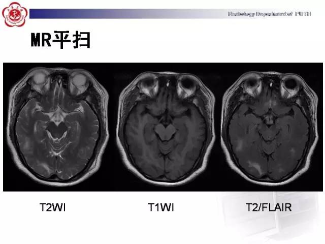 【病例】可逆性后部脑病综合征1例MR影像表现