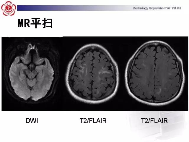 【病例】可逆性后部脑病综合征1例MR影像表现