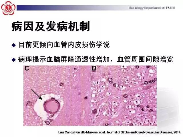 【病例】可逆性后部脑病综合征1例MR影像表现