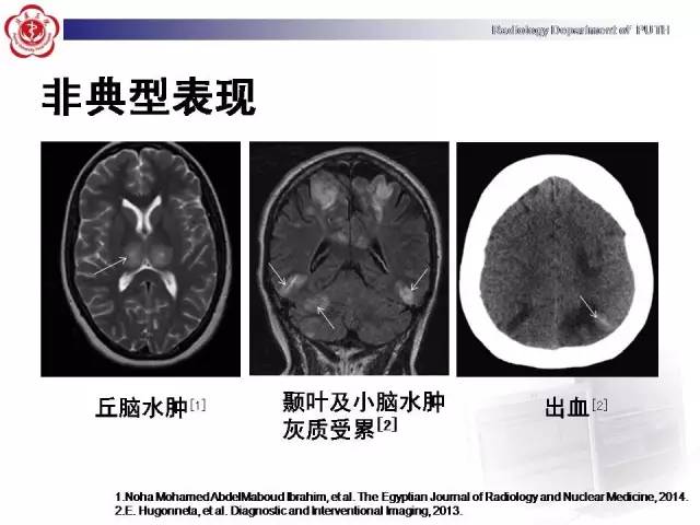 【病例】可逆性后部脑病综合征1例MR影像表现