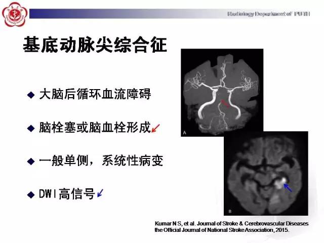 【病例】可逆性后部脑病综合征1例MR影像表现