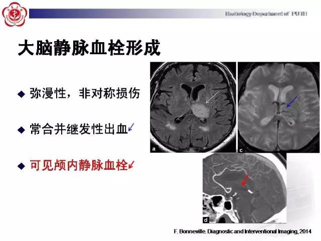 【病例】可逆性后部脑病综合征1例MR影像表现