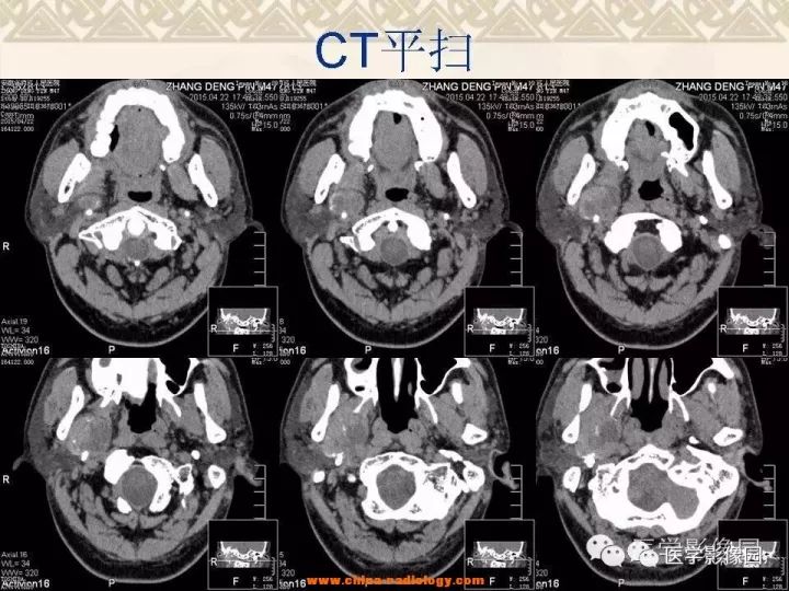【病例】颅底软骨母细胞瘤1例CT影像表现