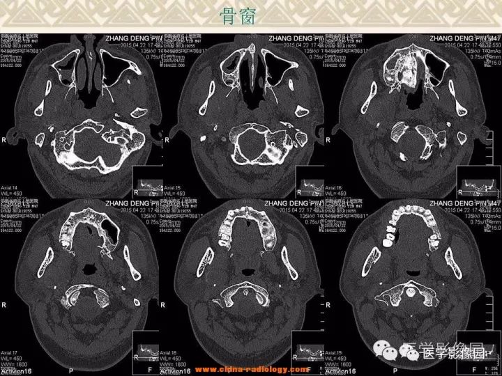 【病例】颅底软骨母细胞瘤1例CT影像表现 【病例】颅底软骨母细胞瘤1例CT影像表现
