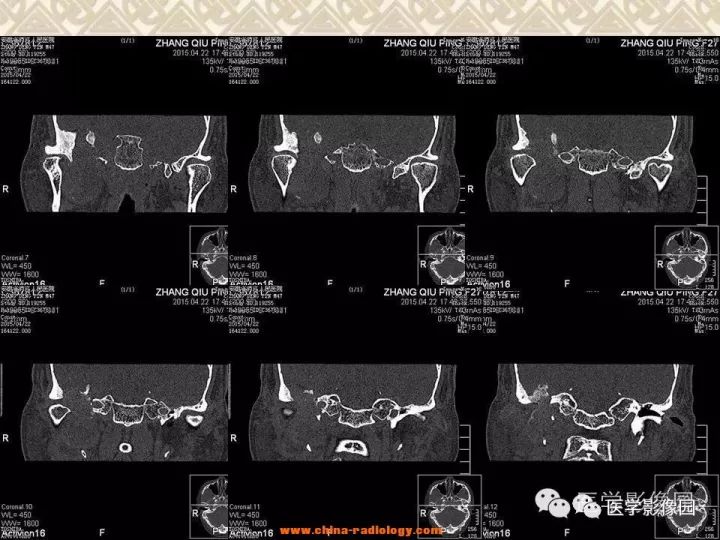 【病例】颅底软骨母细胞瘤1例CT影像表现 【病例】颅底软骨母细胞瘤1例CT影像表现