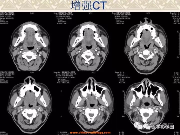 【病例】颅底软骨母细胞瘤1例CT影像表现 【病例】颅底软骨母细胞瘤1例CT影像表现