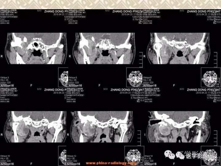 【病例】颅底软骨母细胞瘤1例CT影像表现 【病例】颅底软骨母细胞瘤1例CT影像表现