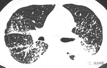 HRCT影像:周边型淋巴管结节之结节病 HRCT影像:周边型淋巴管结节之结节病