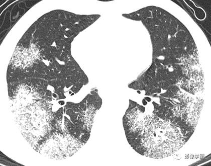 HRCT影像:周边型淋巴管结节之结节病 HRCT影像:周边型淋巴管结节之结节病