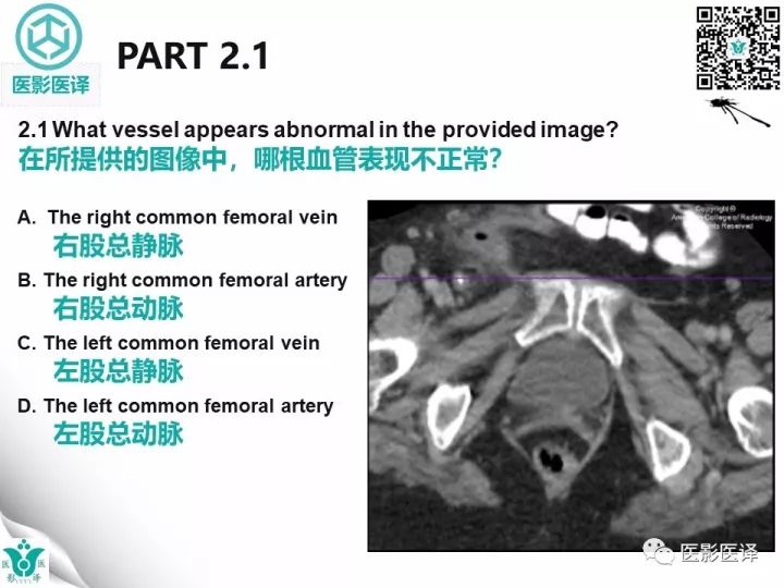 【病例】股疝阑尾炎破裂1例CT影像表现 【病例】股疝阑尾炎破裂1例CT影像表现