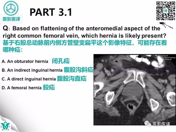 【病例】股疝阑尾炎破裂1例CT影像表现 【病例】股疝阑尾炎破裂1例CT影像表现