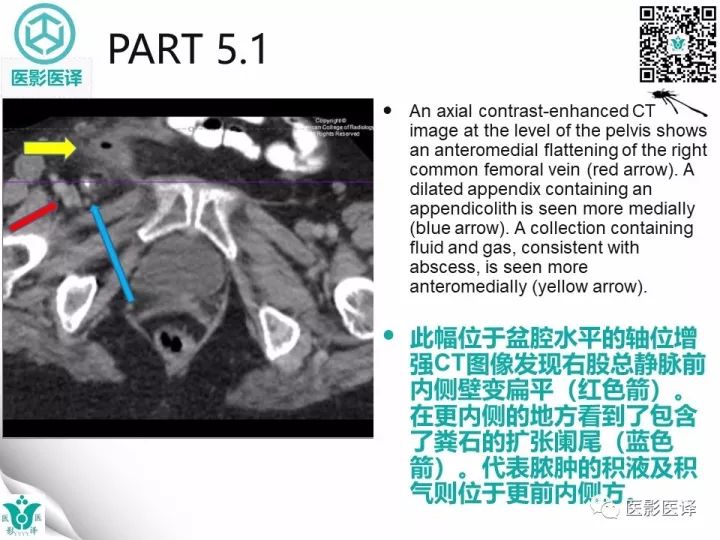 【病例】股疝阑尾炎破裂1例CT影像表现 【病例】股疝阑尾炎破裂1例CT影像表现