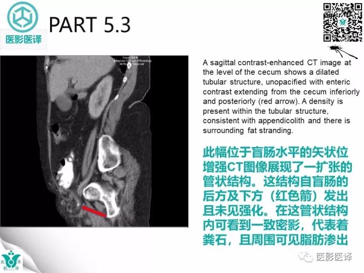 【病例】股疝阑尾炎破裂1例CT影像表现 【病例】股疝阑尾炎破裂1例CT影像表现