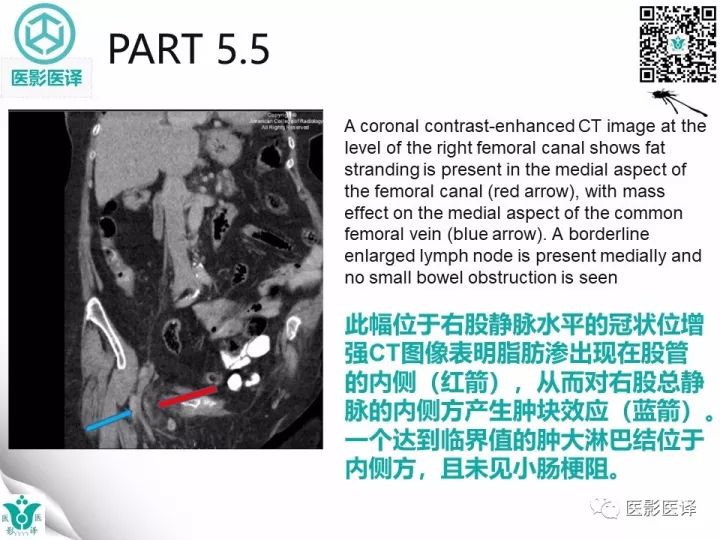 【病例】股疝阑尾炎破裂1例CT影像表现 【病例】股疝阑尾炎破裂1例CT影像表现