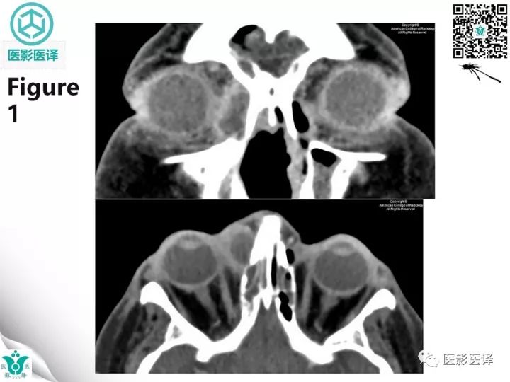 【病例】滥用可卡因致鼻中隔穿孔、全鼻窦炎、泪囊炎1例CT 【病例】滥用可卡因致鼻中隔穿孔、全鼻窦炎、泪囊炎1例CT