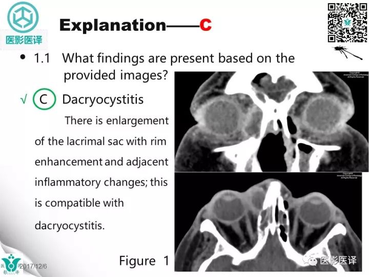 【病例】滥用可卡因致鼻中隔穿孔、全鼻窦炎、泪囊炎1例CT 【病例】滥用可卡因致鼻中隔穿孔、全鼻窦炎、泪囊炎1例CT
