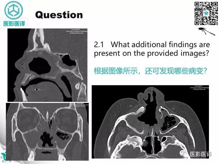 【病例】滥用可卡因致鼻中隔穿孔、全鼻窦炎、泪囊炎1例CT 【病例】滥用可卡因致鼻中隔穿孔、全鼻窦炎、泪囊炎1例CT