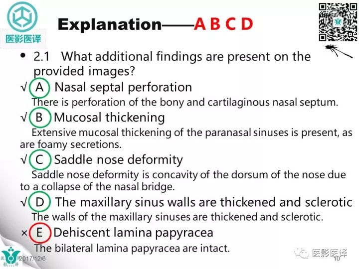 【病例】滥用可卡因致鼻中隔穿孔、全鼻窦炎、泪囊炎1例CT 【病例】滥用可卡因致鼻中隔穿孔、全鼻窦炎、泪囊炎1例CT