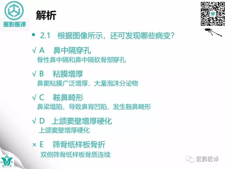 【病例】滥用可卡因致鼻中隔穿孔、全鼻窦炎、泪囊炎1例CT 【病例】滥用可卡因致鼻中隔穿孔、全鼻窦炎、泪囊炎1例CT
