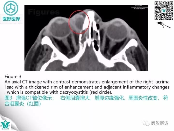 【病例】滥用可卡因致鼻中隔穿孔、全鼻窦炎、泪囊炎1例CT 【病例】滥用可卡因致鼻中隔穿孔、全鼻窦炎、泪囊炎1例CT