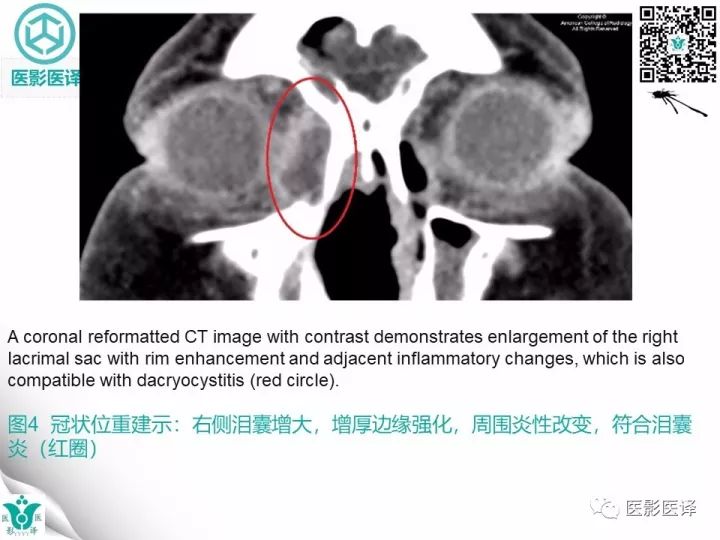 【病例】滥用可卡因致鼻中隔穿孔、全鼻窦炎、泪囊炎1例CT 【病例】滥用可卡因致鼻中隔穿孔、全鼻窦炎、泪囊炎1例CT