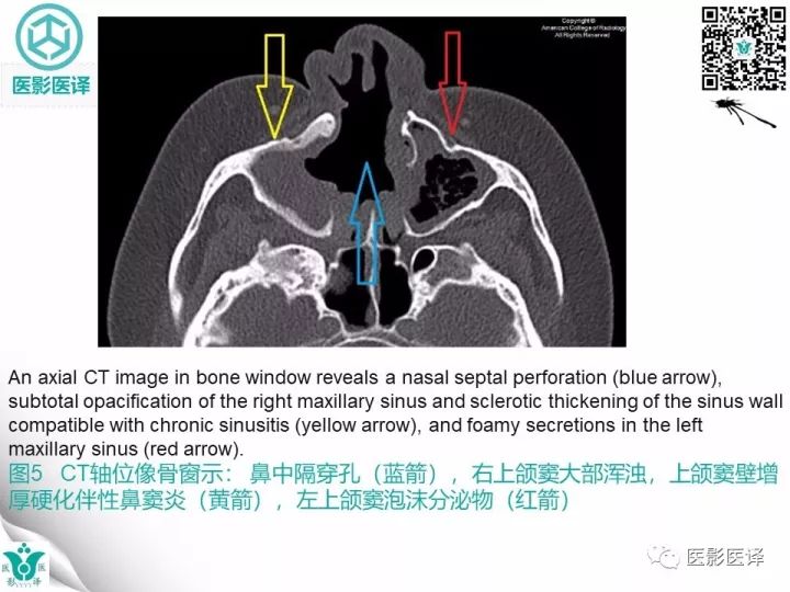 【病例】滥用可卡因致鼻中隔穿孔、全鼻窦炎、泪囊炎1例CT 【病例】滥用可卡因致鼻中隔穿孔、全鼻窦炎、泪囊炎1例CT