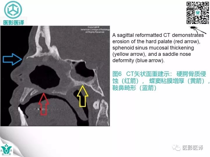【病例】滥用可卡因致鼻中隔穿孔、全鼻窦炎、泪囊炎1例CT 【病例】滥用可卡因致鼻中隔穿孔、全鼻窦炎、泪囊炎1例CT