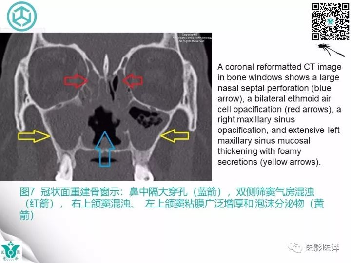 【病例】滥用可卡因致鼻中隔穿孔、全鼻窦炎、泪囊炎1例CT 【病例】滥用可卡因致鼻中隔穿孔、全鼻窦炎、泪囊炎1例CT