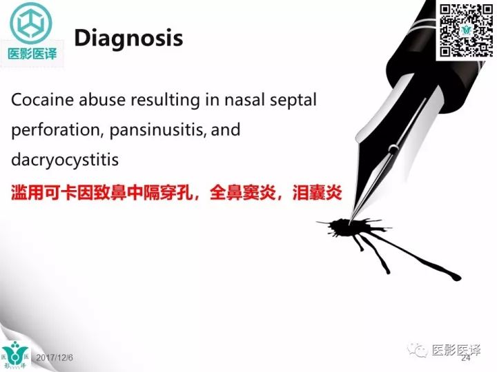 【病例】滥用可卡因致鼻中隔穿孔、全鼻窦炎、泪囊炎1例CT 【病例】滥用可卡因致鼻中隔穿孔、全鼻窦炎、泪囊炎1例CT