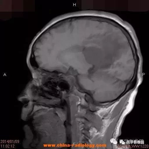 【病例】脑室淋巴瘤1例CT及MR影像表现 【病例】脑室淋巴瘤1例CT及MR影像表现