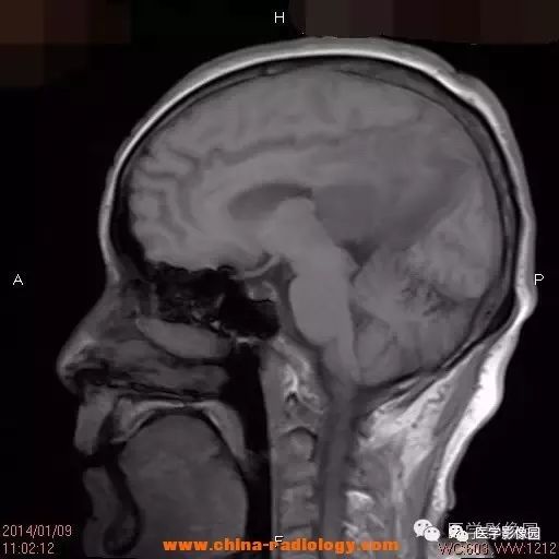 【病例】脑室淋巴瘤1例CT及MR影像表现 【病例】脑室淋巴瘤1例CT及MR影像表现
