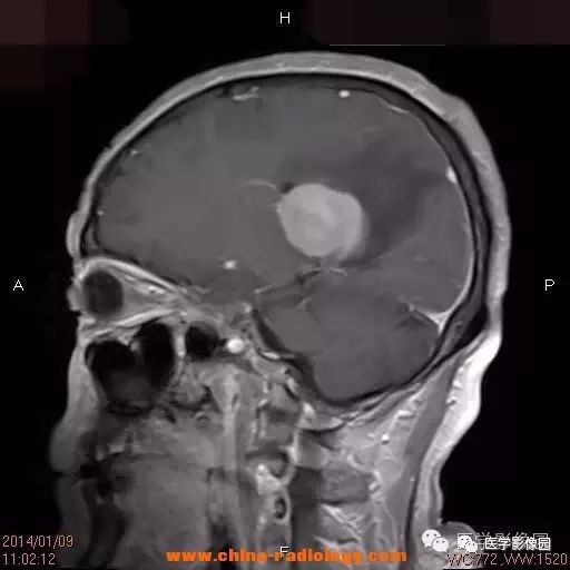 【病例】脑室淋巴瘤1例CT及MR影像表现 【病例】脑室淋巴瘤1例CT及MR影像表现