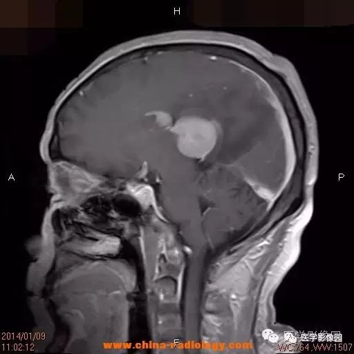 【病例】脑室淋巴瘤1例CT及MR影像表现 【病例】脑室淋巴瘤1例CT及MR影像表现