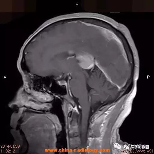 【病例】脑室淋巴瘤1例CT及MR影像表现 【病例】脑室淋巴瘤1例CT及MR影像表现