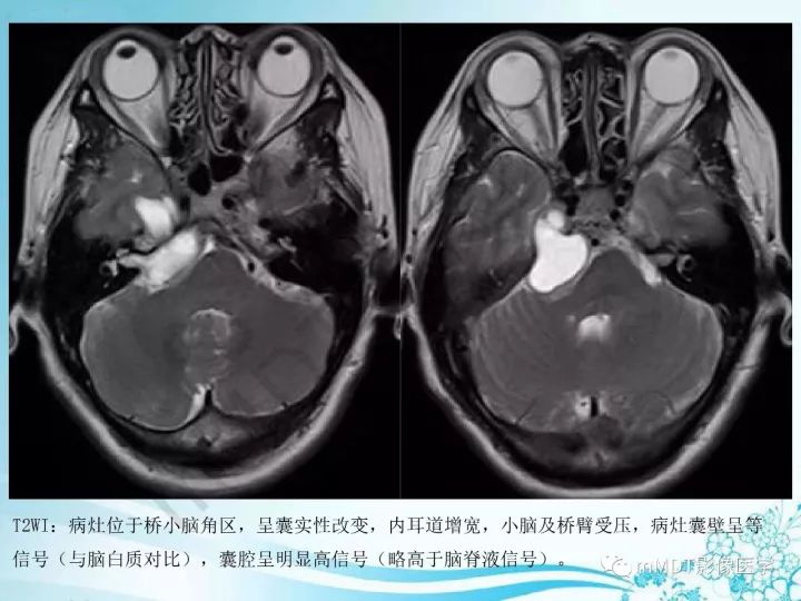 【PPT】听神经鞘瘤