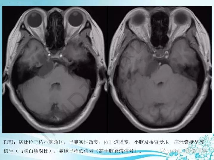 【PPT】听神经鞘瘤